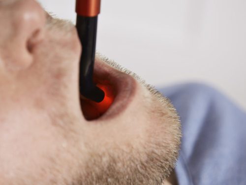 Energy-Laser L500 Pro softlaser (LLLT)