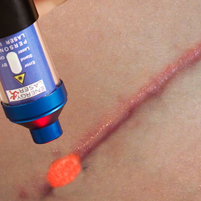 Soft laser devices