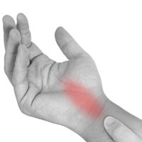 Carpal Tunnel Syndrome