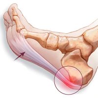 Plantar fasciitis