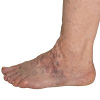 Post-thrombosis condition