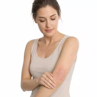 Eczema