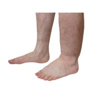Edema Treatment