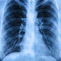 Cystic fibrosis