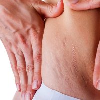 Stretch Mark Treatment