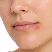 Herpes