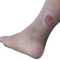 Leg Ulcer