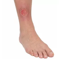Leg ulcer