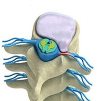 Herniated Disc