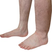 Vascular and Lymphatic Diseases