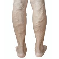 Varicose Vein Treatment