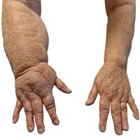 Lymphoedema - lymphedema