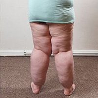 Lipoedema (Fat edema)
