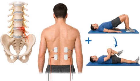 Muscle stimulation and physiotherapy in disc herniation rehabilitation