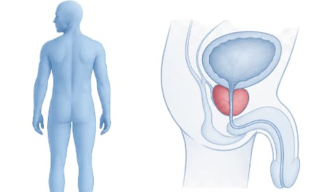 Penile rehabilitation after prostate surgery – vacuum training protocol