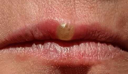 Lip herpes softlaser treatment – Case study with photos