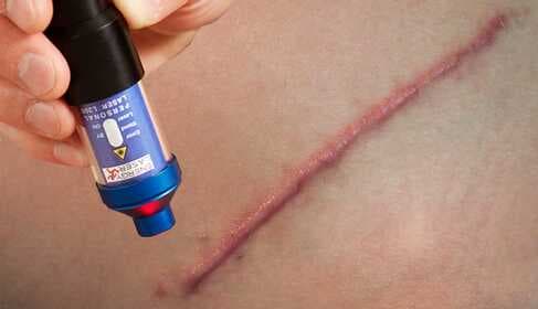 Soft Laser Treatment for Scars and Keloids – Home Therapy