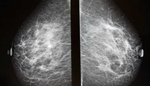 Mammography — what you need to know