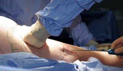 Liposuction — what you need to know