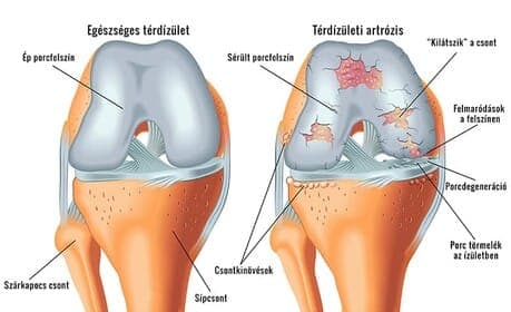 Knee osteoarthritis – a common joint disease