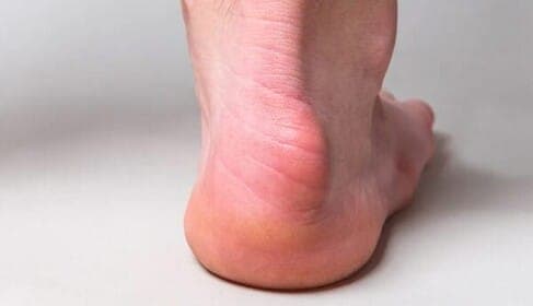 Causes of Heel Pain