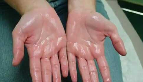 Hyperhidrosis — abnormal sweating