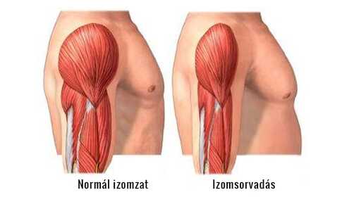 Muscle atrophy, the gradual breakdown of muscle tissue