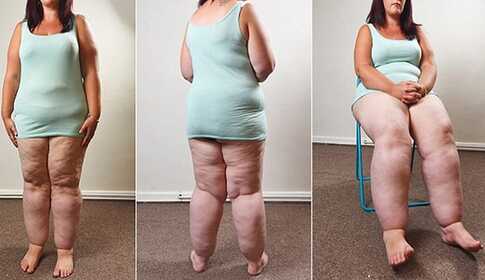 Lipedema (fat edema) — symptoms and treatment