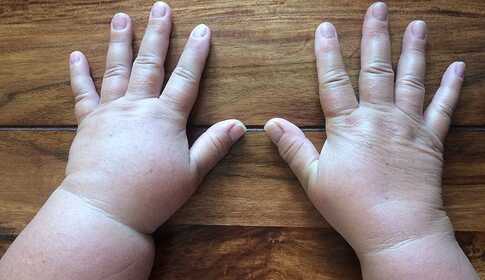 Lymphedema Treatment at Home