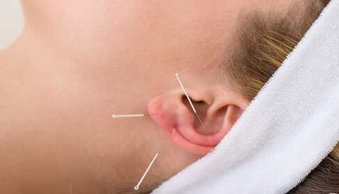 Acupuncture — Mysticism or Biophysics?