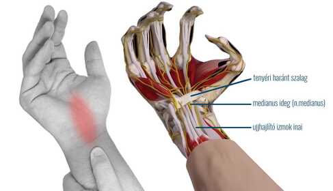Treatment Options for Tunnel Syndrome