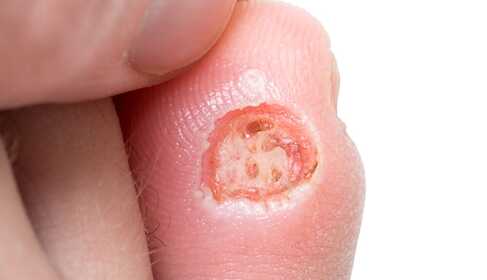 Diabetic foot – what can you do to prevent it?
