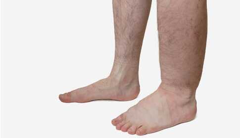 Causes and Treatment of Leg Swelling (Edema)