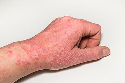 Dermatological problems and salt therapy – Complementary treatment for eczema and psoriasis