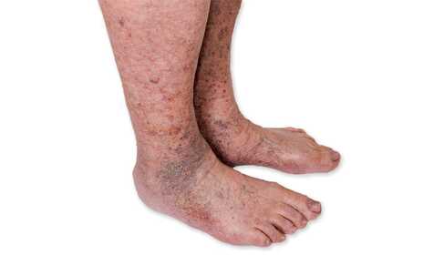 Reddish-brown spot on the shin. What is it?