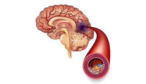 Stroke – not only a brain-affecting 