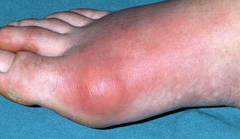 Gout symptoms and treatment