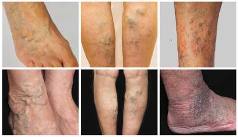 Leg ulcer – healing with muscle stimulation