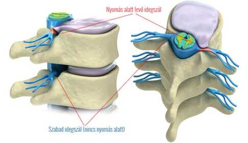 Herniated Disc – What Can You Do About It?