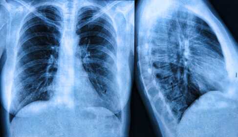 What Can Cause a Shadow on the Lung? The Chest X‑Ray Examination