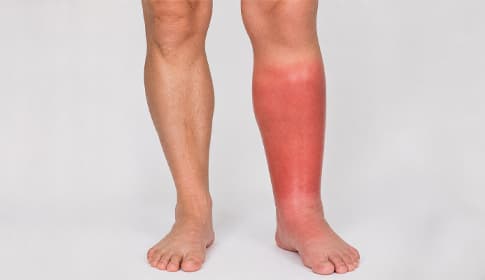 Erysipelas, a bacterial skin infection