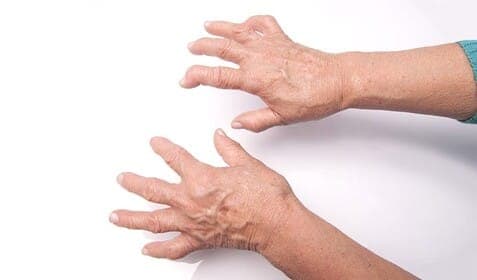 Rheumatoid arthritis, one of the most serious musculoskeletal diseases