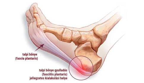 Plantar fascia inflammation, i.e. plantar fasciitis