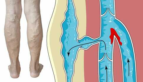 Thrombosis – when your vein is blocked