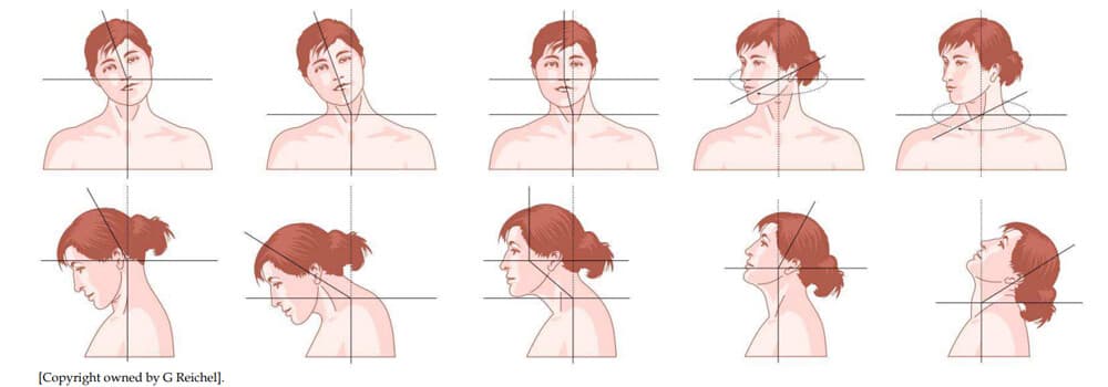 torticollis ferde nyak irányai