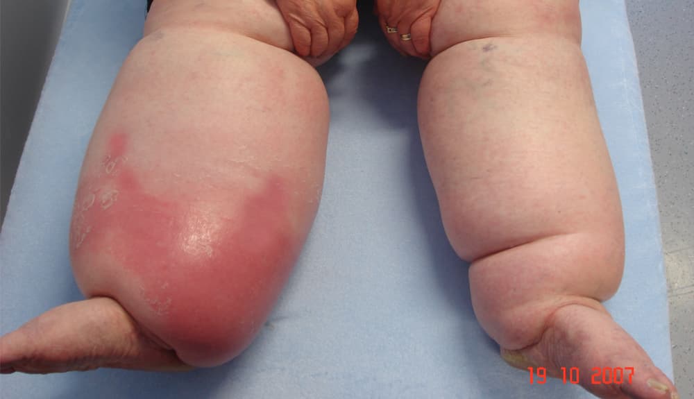 orbánc, erysipelas, a bőr bakteriális fertőzése