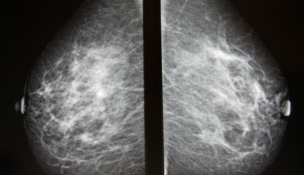 mammography, breast cancer screening, breast screening