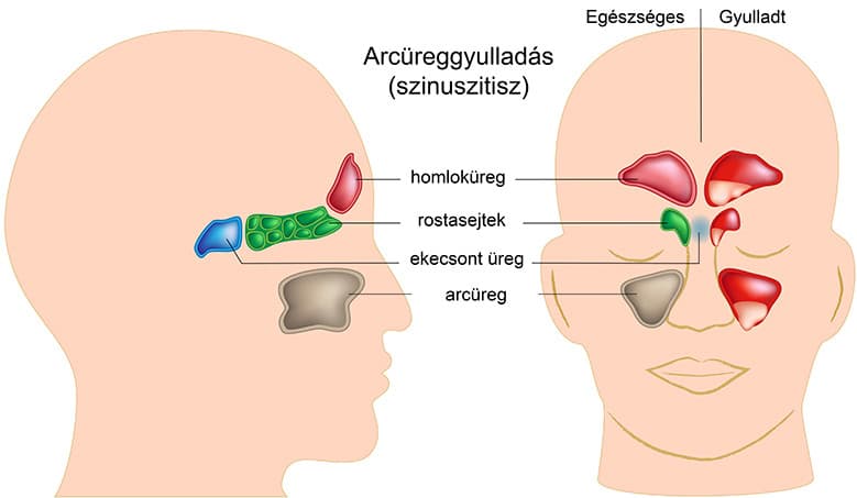 Location of the sinuses and the development of sinusitis