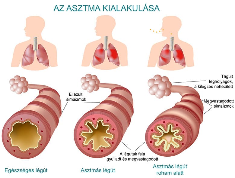 Development of asthma and changes in the airways