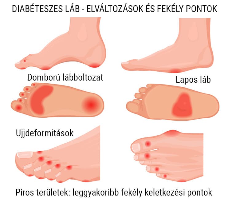 Diabetic-foot-changes-and-ulcer-points.jpg